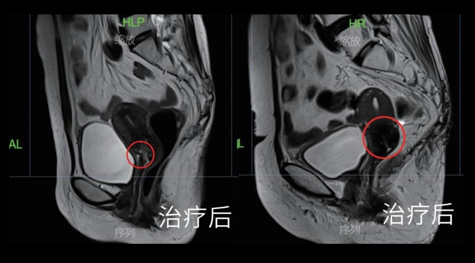 宫颈癌 III B期巨大肿瘤治疗后影像