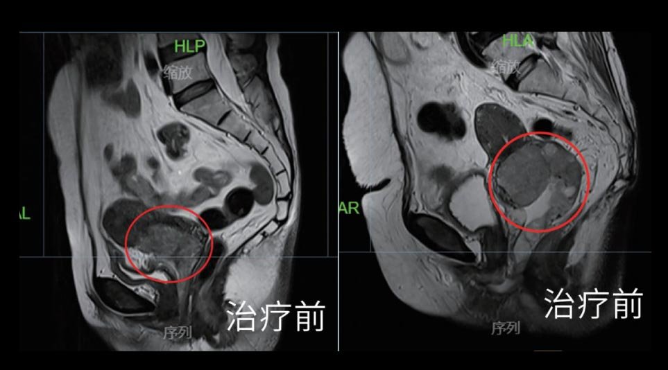 宫颈癌 III B期巨大肿瘤治疗前影像