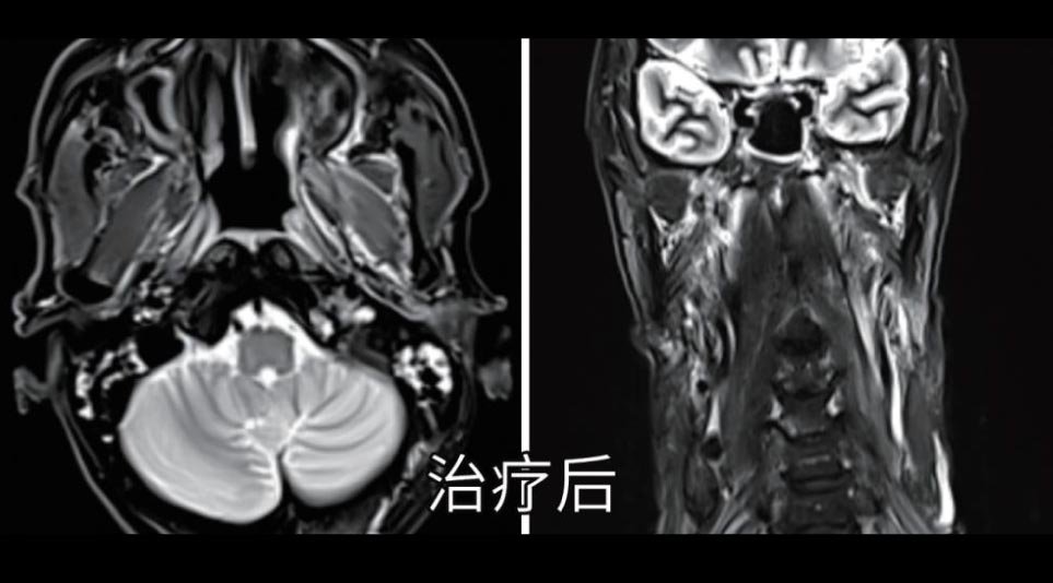 鼻咽癌根治性放疗治疗后复查影像