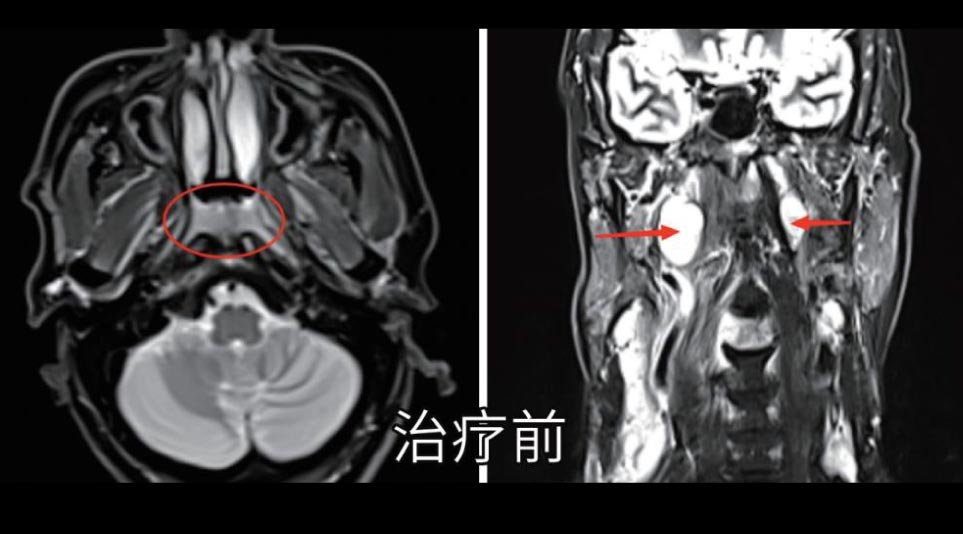 鼻咽癌根治性放疗治疗前影像