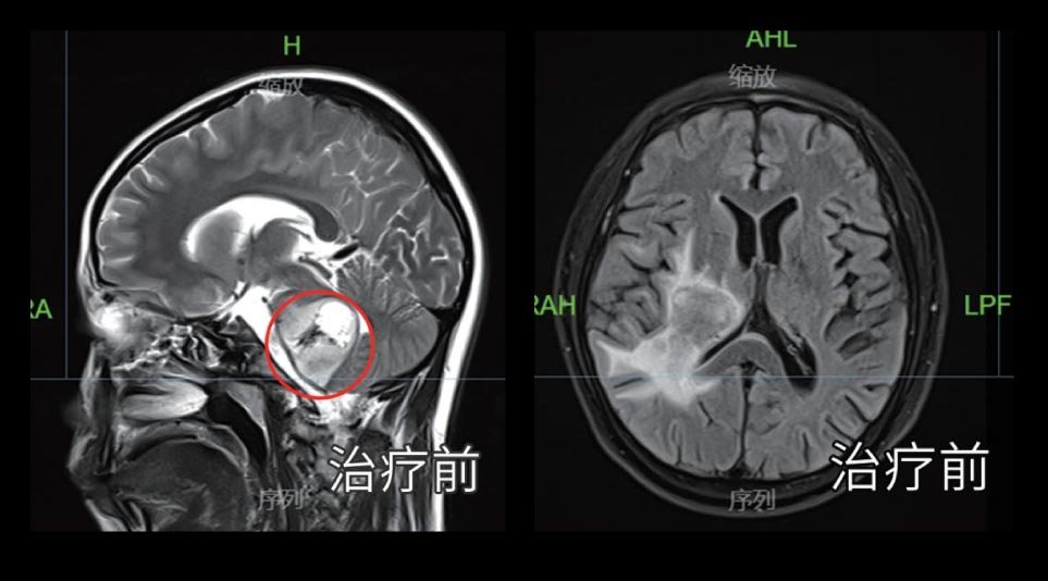 9岁儿童颅内肿瘤治疗前脑部 MRI / CT