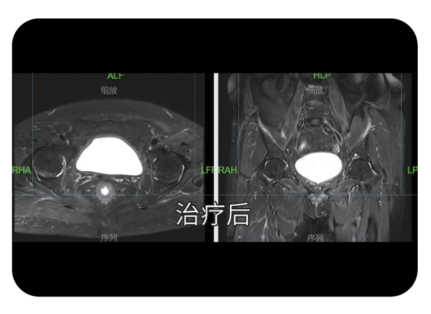 膀胱癌高效率精准放疗病例治疗后复查影像