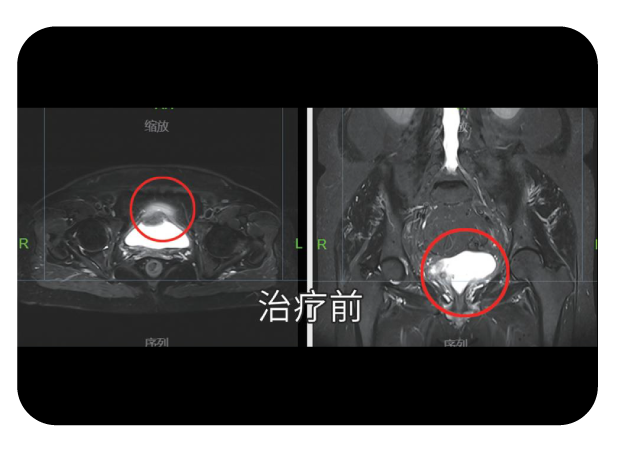 膀胱癌高效率精准放疗病例治疗前影像