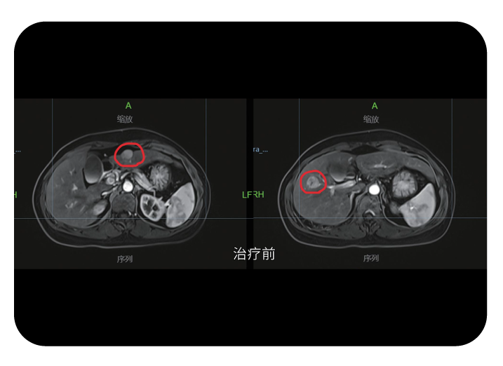 肝脏肿瘤立体定向放疗病例治疗前影像