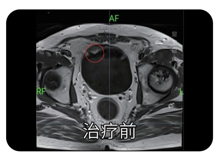 膀胱癌自适应放疗治疗前影像
