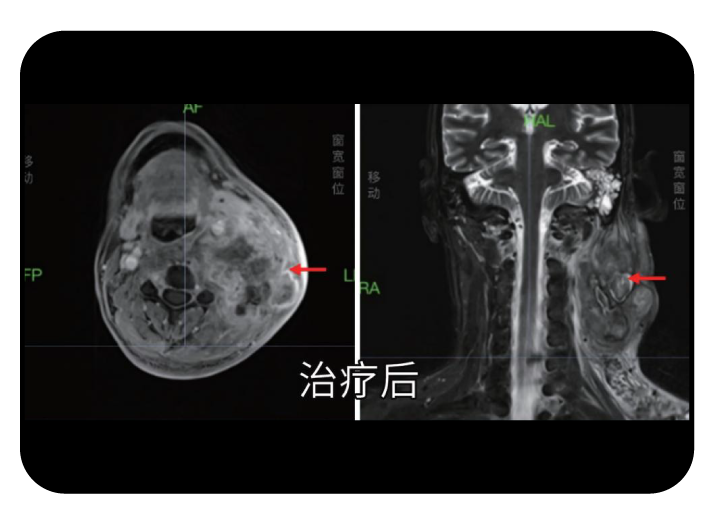 鼻咽癌精准放疗病例治疗后复查影像