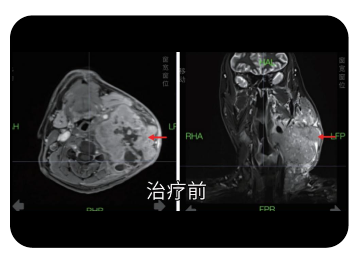 鼻咽癌精准放疗病例治疗前影像